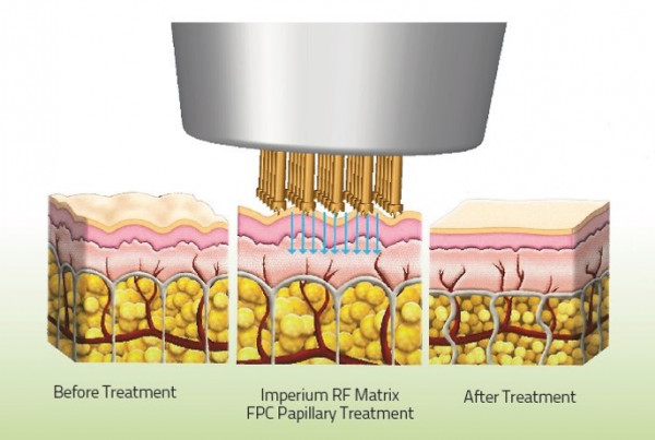 Fractionele Pulsed Crown RF